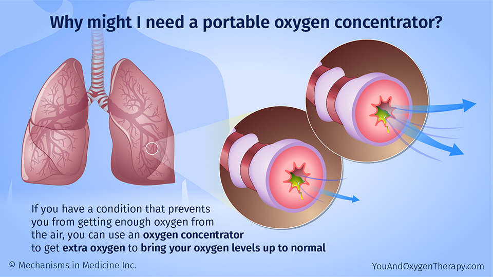 Why might I need a portable oxygen concentrator?